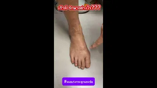  ทำไมต้องตรวจปัสสาวะ 24 ชั่วโมง เมื่อสงสัยว่ามีโรคเก๊าท 