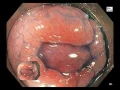 Download Lagu Infectious colitis