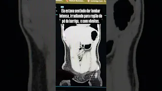 #calculorenal #tomografiacomputadorizada #dorabdominal #ctscan #kidneydisease