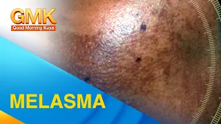 melasma cause and treatment explained by dermatologist