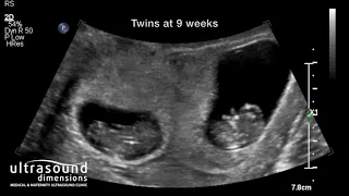 Scan of the Week Twins at 9 weeks gestation
