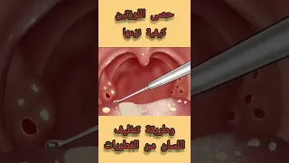 حصى اللوزتين علاجها وطريقة تنظيف اللسان من الفطريات 