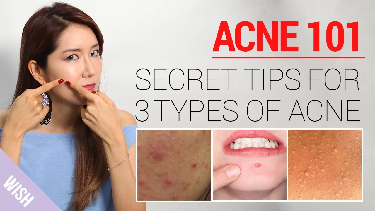 
          
          
          
            
            Acne 101: How to Take Care of Acne At Home (Types & Treatment) | Wishtrend
          
        . 