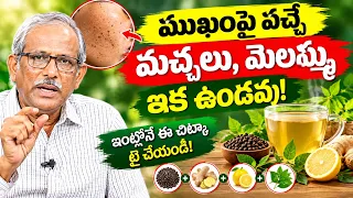 నొప్పి లేకుండా పులిపిర్లు మాయం | Instantly Remove Warts | Remedies For Pulipirlu