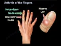 Download Lagu Arthritis of the Fingers Explained