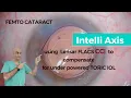 Download Lagu Innovative use  of  CCI  and  Toric IOL combination  using Intelli axis in  FEMTO -Dr Kamal B Kapur