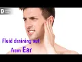 Download Lagu Fluid coming out from Ear | Is it pus? Best Treatment - Dr. Harihara Murthy |Doctors' Circle