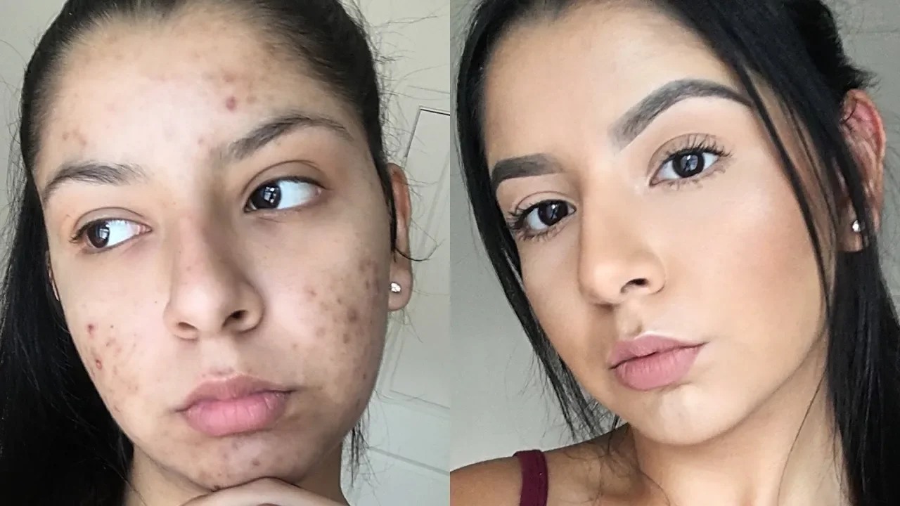 Hi ! Thank you for watching and don't forget for SUBSRIBE , LIKE , COMMENT Disclaimer: I'm not a doc. 