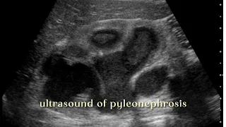 Ultrasound Imaging of Pyelonephrosis What You Need to Know