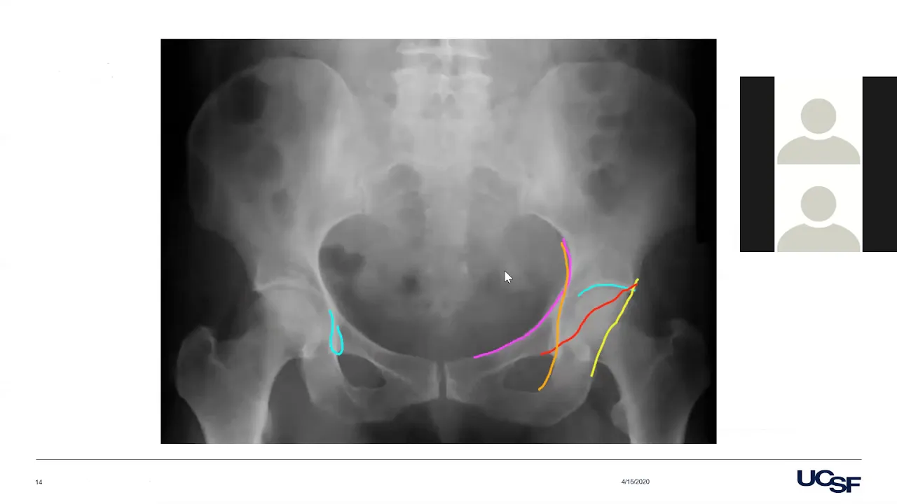 Hip Evaluation, Imaging and THA Principles - Dr. Barry