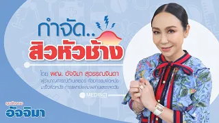 การรักษาสิวหัวช้างทำอย่างไรบ้าง
