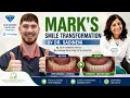 Mark s Smile Journey Fixing Bottom Teeth Crowding Teeth Grinding Invisalign with Dr Sadineni