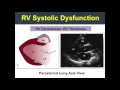 The RV in Pulmonary Arterial Hypertension and RV Therapies