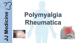 Download Polymyalgia Rheumatica | Signs \u0026 Symptoms, Diagnosis and Treatment MP3