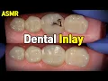 Dental Inlay Procedure