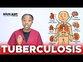 Tuberculosis One Germ Many Battles
