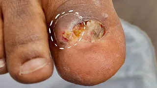what is hiding inside this infected toe