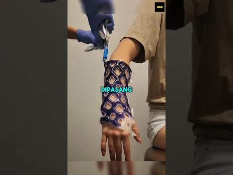 Gips Unik ini Punya Solusi Buat Rasa Gatal!
