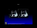 Download Lagu MV Replacement vs Repair for Secondary MR. Repair It! - Gorav Ailawadi, MD