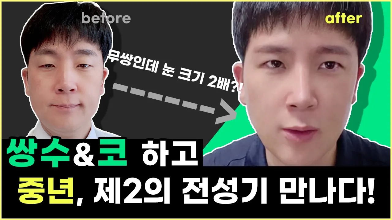 40대중년 남자, 쌍수+코하고 제2의 전성기로! | 비절개눈매교정, 코성형 Vlog