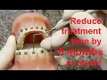 How to Place Position Braces
