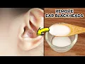 3 Best Ways for Ear Acne Blackheads Removal How to Remove Ear Blackheads at Home
