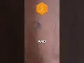 The Stages of Chronic Venous Insufficiency