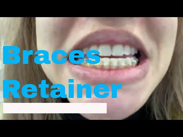 How to wear retainer braces?_English Orhotdontist