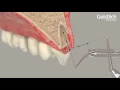 Download Lagu Geistlich Bio-Gide® Shape - Ridge Preservation (Geistlich Biomaterials)
