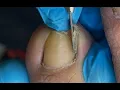 Download Lagu Huge ingrown toenail removal