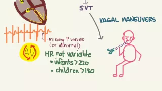 PALS 08 Tachycardias