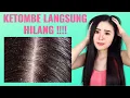 7 Cara Ampuh Menghilangkan Ketombe Secara Alami (TANPA BIAYA)