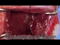 Download Lagu Spatiotemporal  delivery of nanoformulated liraglutide - Supplementary video 1 [132064]