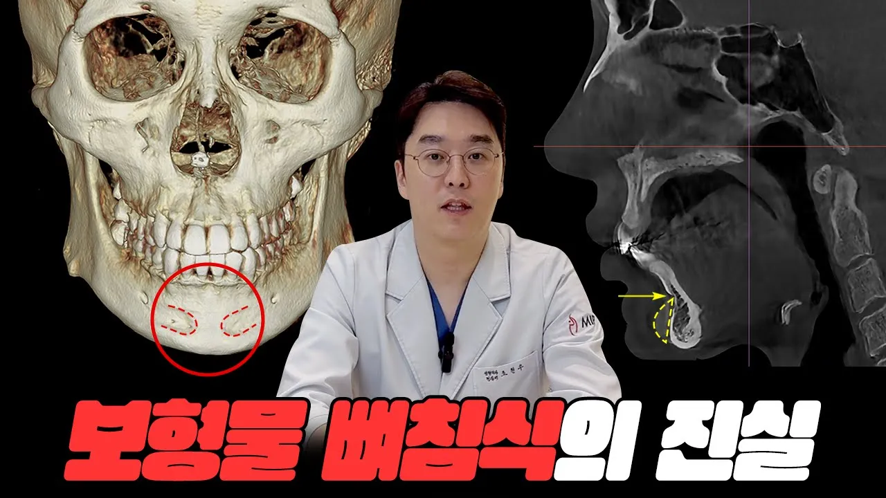 턱끝 필러/보형물 오래 될수록 뼈침식이 더 많이 생길수도 있나요?
