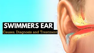 Say Goodbye to Swimmer s Ear Effective Treatment Options
