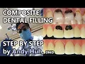 Composite Dental Filling Procedure Steps Tooth-colored White Andy Huh Evergreen Dental