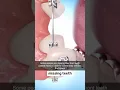 Fixing Missing Teeth With Braces