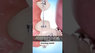 Fixing Missing Teeth With Braces
