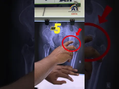 What happens to Hip joint Gap in Arthritis? Dr Ramprasad Explains