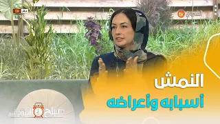 تعرف مع الطبية المختصة في أمراض الجلد على  النمش    أسبابه وأعراضه دندنها