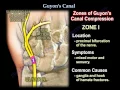 Download Lagu Guyon's Canal , Ulnar tunnel syndrome .Everything You Need To Know - Dr. Nabil Ebraheim