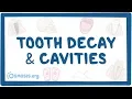 Tooth decay and cavities - causes symptoms diagnosis treatment pathology