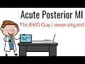 Acute Posterior MI on EKG ECG l The EKG Guy - www ekg md