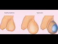 Puncture aspiration of hydrocele CPT code - simplify medical coding