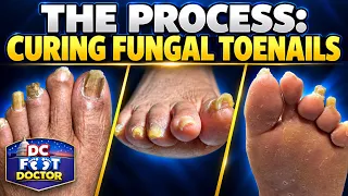 The Process: Curing Fungal Toenails