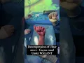 Download Lagu Decompression of Ulnar nerve Guyon canal Under Walant