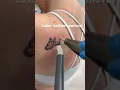 Download Lagu We are world’s fastest tattoo removal because  ART #tattoremoval #tattooremovalexperts