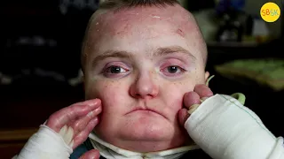 The Boy With Butterfly Skin and Profound Autism