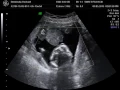 Gender Reveal