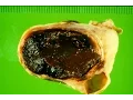 Endometriosis - Pathology mini tutorial